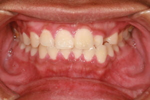 Gingivitis 2