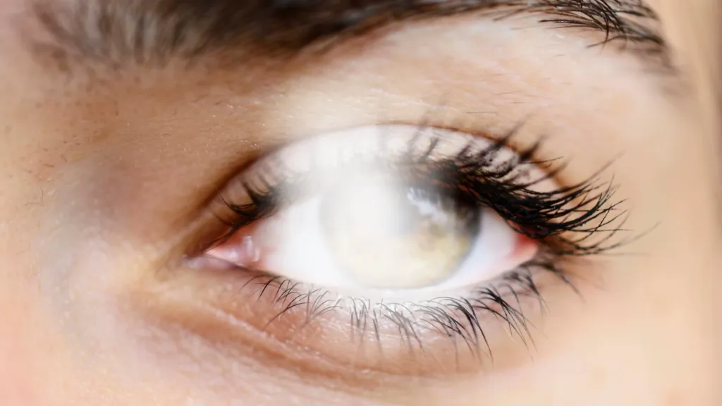 https://decare23.proactivedigital.ie/wp-content/uploads/2024/03/Blurry-Vision-640x300-c-default.webp