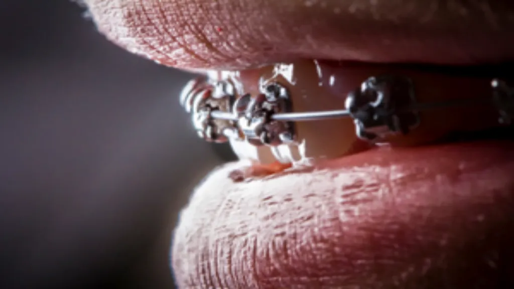 https://decare23.proactivedigital.ie/wp-content/uploads/2024/03/Braces-image-CP-640x300-c-default.webp