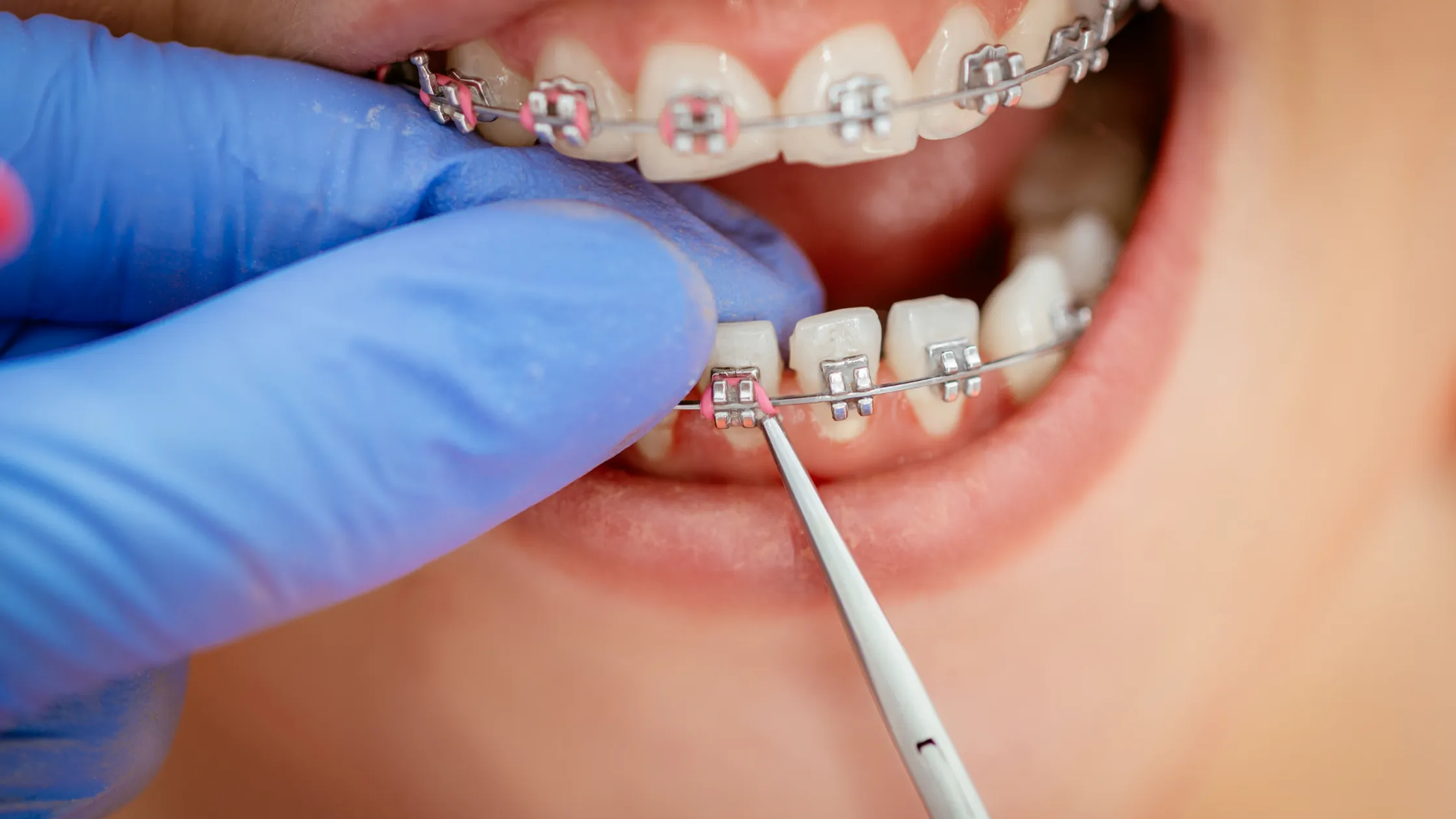 https://decare23.proactivedigital.ie/wp-content/uploads/2024/03/Braces.webp
