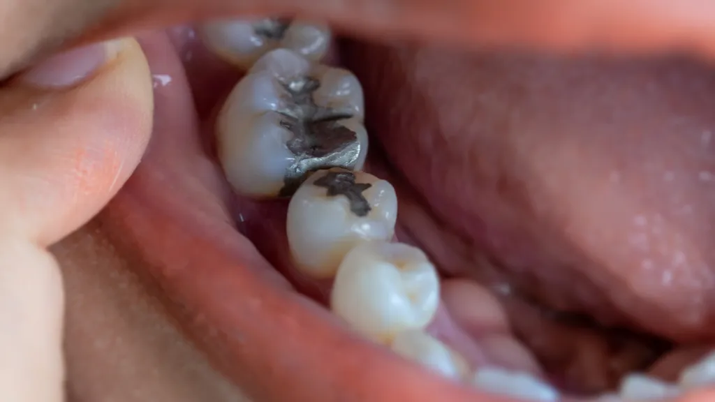 https://decare23.proactivedigital.ie/wp-content/uploads/2024/03/Fillings-blog-photos-640x300-c-default.webp