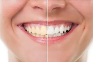 https://decare23.proactivedigital.ie/wp-content/uploads/2024/03/Tooth-Whitening-CP.webp