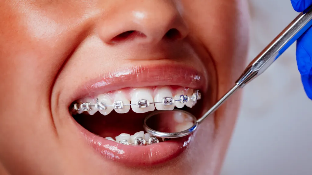 https://decare23.proactivedigital.ie/wp-content/uploads/2024/03/White-Spots-on-teeth-CP-640x300-c-default.webp