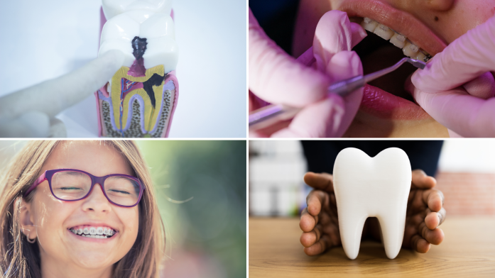 A common experience for those who are wearing braces is for white spots to develop on the teeth while wearing braces. These spots are usually more visible on front teeth but on closer inspection they can also be observed on back teeth. They are usually chalky white in colour and contrast with the normal creamy white colour of surrounding enamel. The spots are not caused directly by the braces themselves but the braces can make it more difficult to carry out normal oral hygiene procedures such as brushing and flossing. 