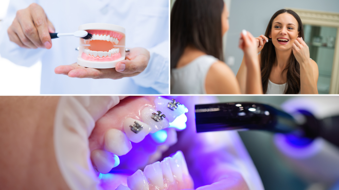 A common experience for those who are wearing braces is for white spots to develop on the teeth while wearing braces. These spots are usually more visible on front teeth but on closer inspection they can also be observed on back teeth. They are usually chalky white in colour and contrast with the normal creamy white colour of surrounding enamel. The spots are not caused directly by the braces themselves but the braces can make it more difficult to carry out normal oral hygiene procedures such as brushing and flossing. 